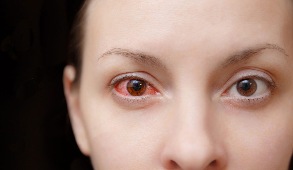 Série Doenças Oculares: #1 CONJUNTIVITE